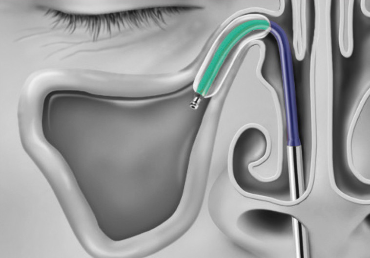 Balloon Sinuplasty in Bakersfield, CA